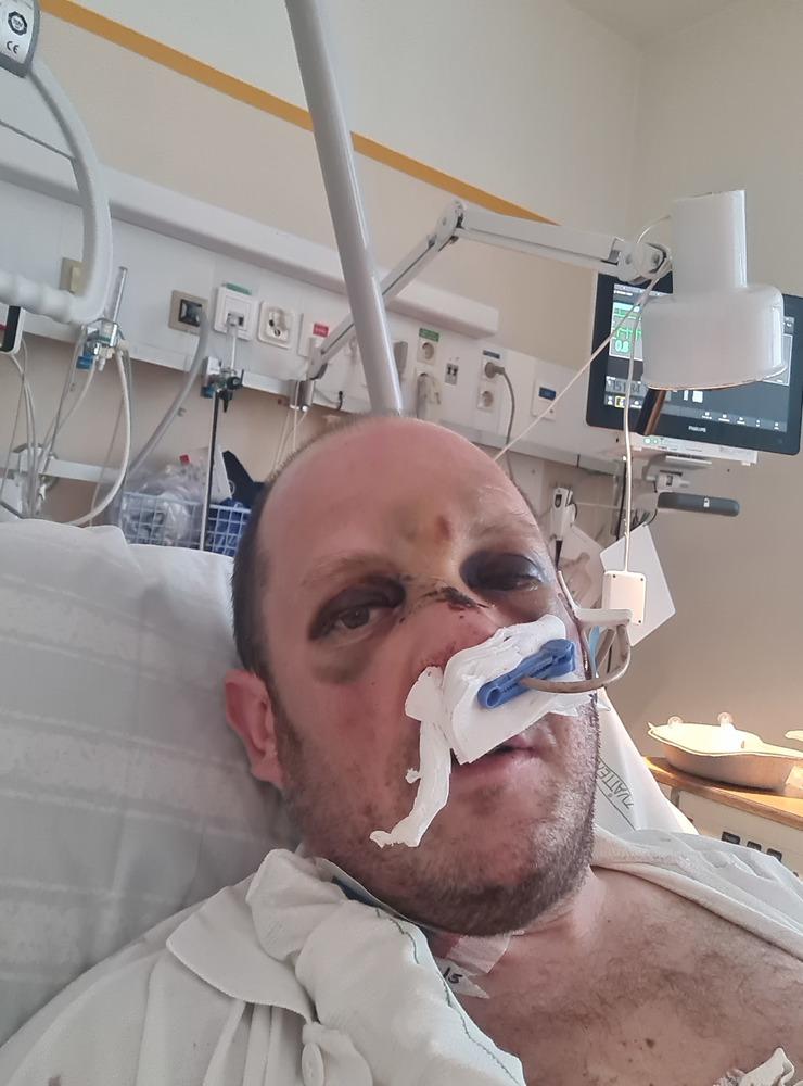 Fredrik vårdades närmare två veckor på sjukhus efter hjärtstoppet i maj, då han även spräckte skallen och bröt näsan på två ställen när han ramlade ihop på jobbet.
